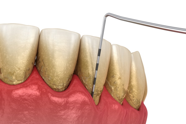 Periodontitis testing,