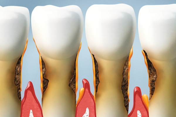 periodontal