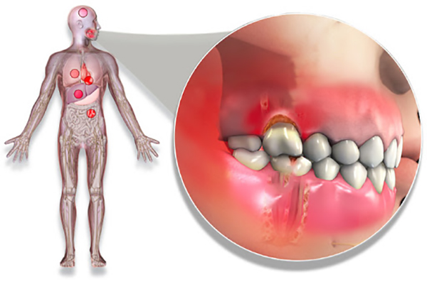 歯周病と全身疾患の関係 杉並区高円寺で歯周病治療 アメリカ式歯周病治療専門サイト